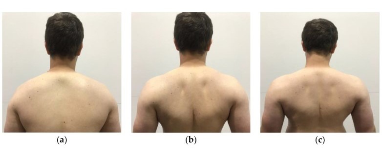 Scapular rotation exercises for Thoracic Outlet Syndrome